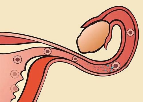 针药并用治疗无排卵性不孕症医案、经典案例