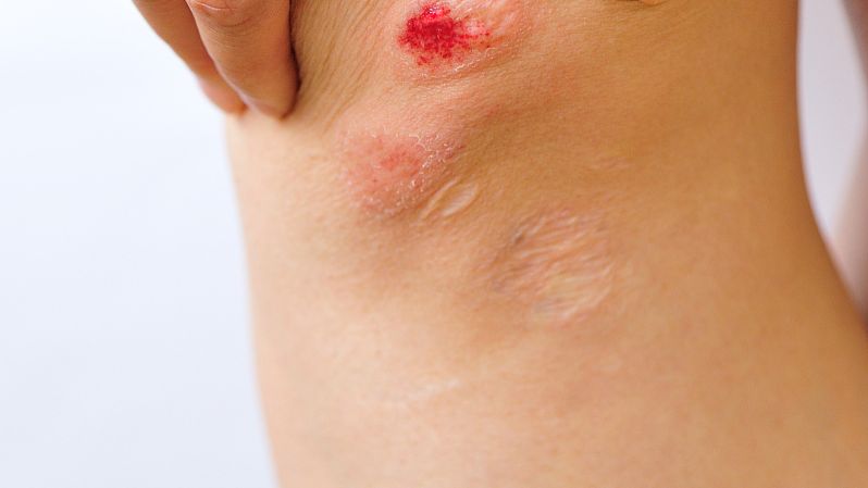 瘢痕青治疗瘢痕疙瘩配方、医案、经典案例