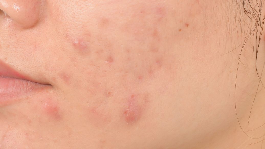 祛疣汤治疗扁平疣配方、医案、经典案例