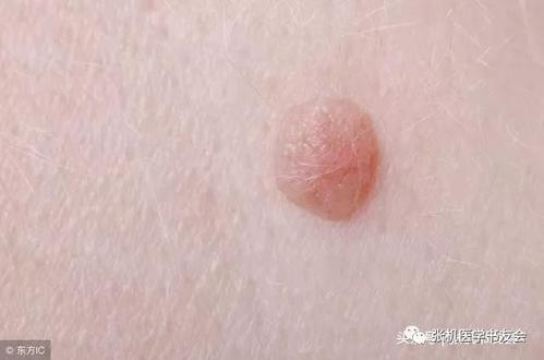 消疣汤治疗扁平疣配方、医案、经典案例