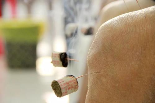 耳穴配合刺血拔罐治疗黄褐斑配方、医案、经典案例