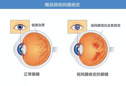 知柏地黄丸加减治糖尿病视网膜病变医案、配方