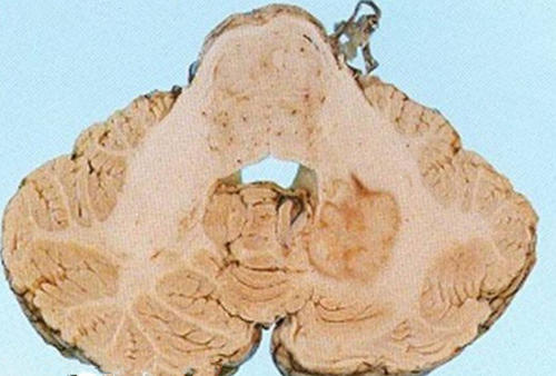 知柏地黄丸加减治非典型结核性脑膜炎所致精神障碍医案、配方