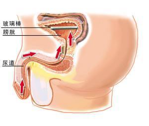 知柏地黄丸加减治癃闭医案、配方