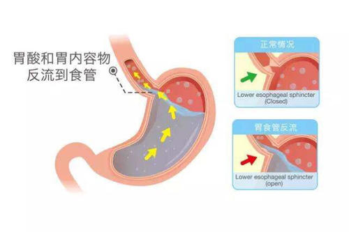 甘露消毒丹加减治胃食管反流病医案、配方