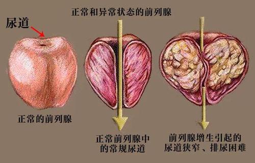 甘露消毒丹加减治上尿路结石医案、配方