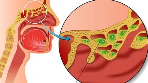 甘露消毒丹加减治急性鼻窦炎医案、配方