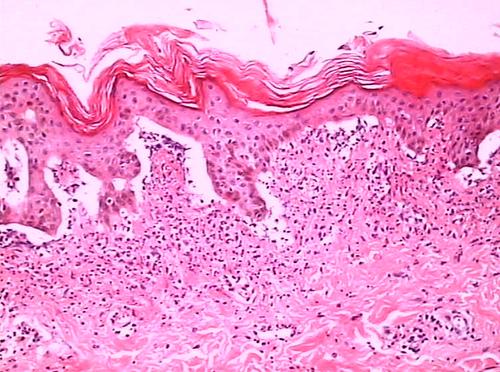 青蒿鳖甲汤加减治系统性红斑狼疮医案、配方