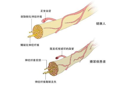 独活寄生汤加减治糖尿病周围神经病变限医案、配方
