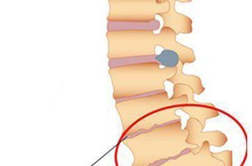独活寄生汤加减治腰椎骨质增生医案、配方