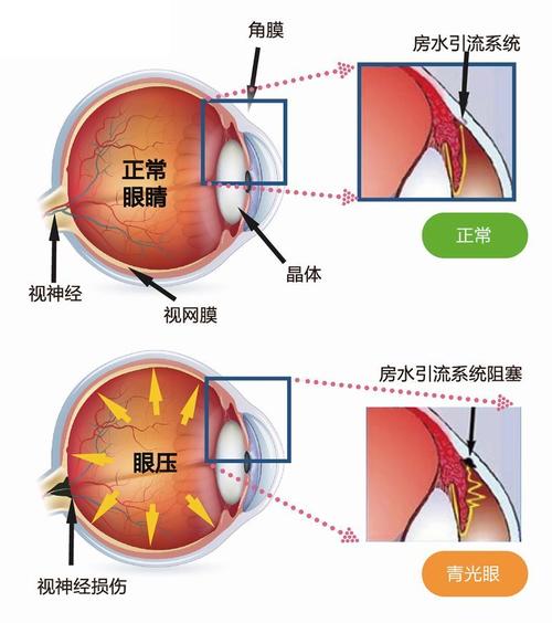 独活寄生汤加减治青光眼医案、配方