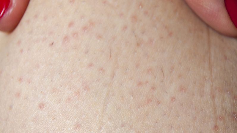独活寄生汤加减治皮肤科疾病医案、配方