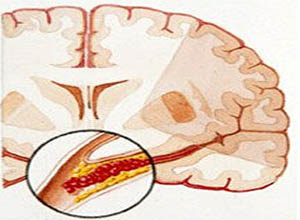 增液汤加减治脑血栓医案、配方