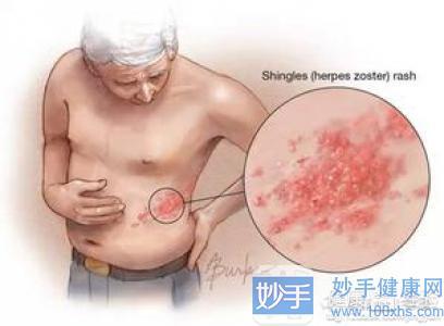 增液汤加减治神经性皮炎医案、配方