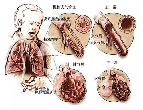 仙方活命饮加减治慢性肺源性心脏病医案、配方
