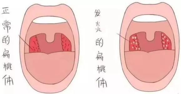 仙方活命饮加减治慢性扁桃体炎医案、配方