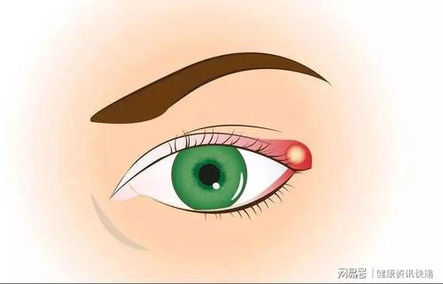 仙方活命饮加减治麦粒肿医案、配方