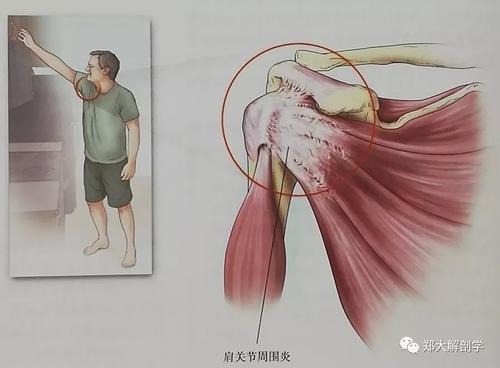 膈下逐瘀汤加减治肩关节周围炎医案、配方