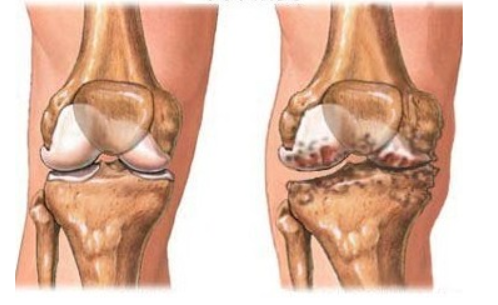 膈下逐瘀汤加减治骨性关节炎医案、配方