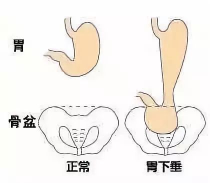 五苓散加减治胃下垂医案、配方