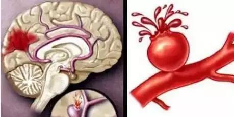 五苓散加减治急性脑血管病医案、配方