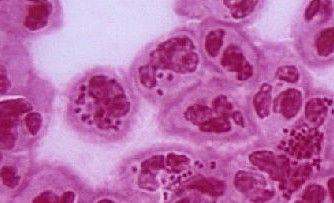 五苓散加减治淋病医案、配方