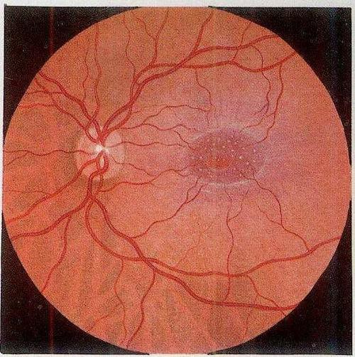 五苓散加减治外伤性近视医案、配方