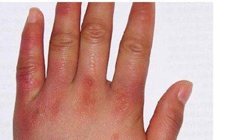 云南白药加减治冻疮医案、配方