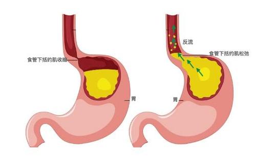 温胆汤加减治反流性食管炎医案、配方
