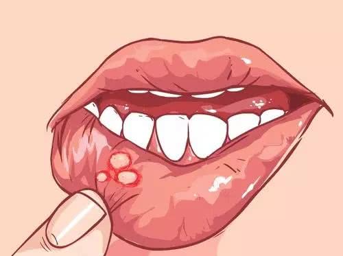 温胆汤加减治顽固性口腔溃疡医案、配方