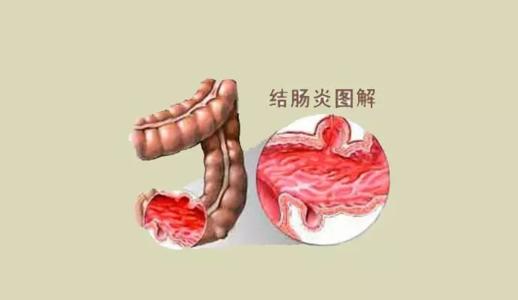 乌梅丸加减治慢性非特异性溃疡性结肠炎医案、配方