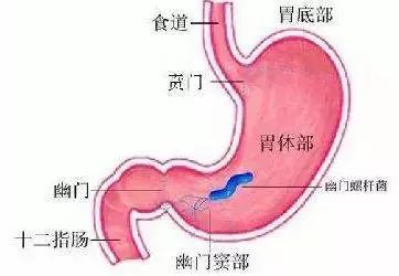 乌梅丸加减治十二指肠球部溃疡医案、配方