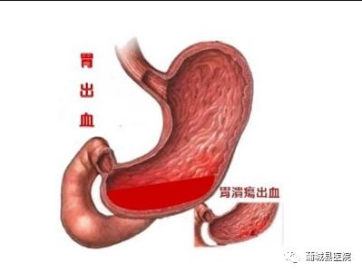 乌梅丸加减治上消化道出血医案、配方