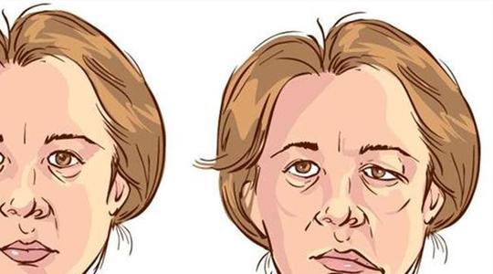 补阳还五汤加减治中风后遗症医案、配方