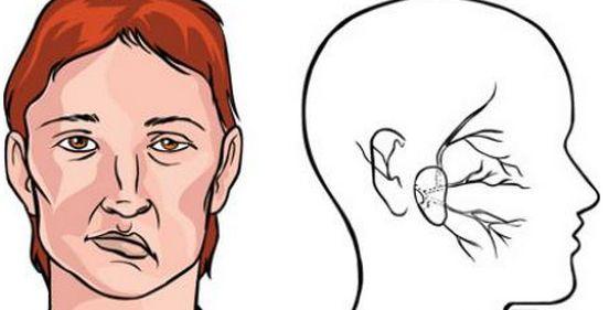补阳还五汤加减治面神经炎医案、配方