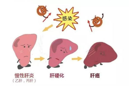 葛根苓连汤加减治慢性乙型病毒性肝炎腹泻医案、配方