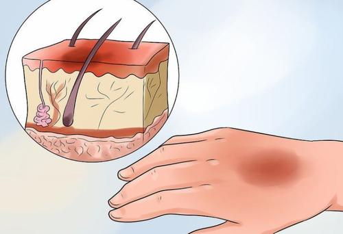 四物汤加减治烧伤后瘢痕增生医案、配方