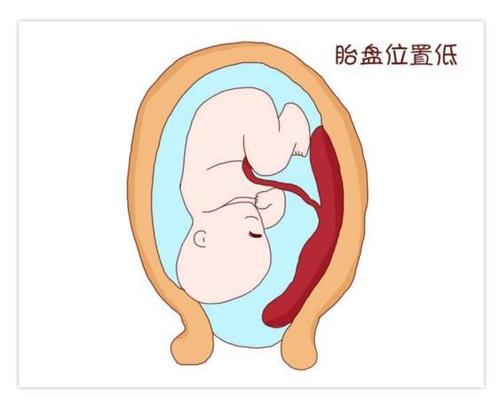 四物汤加减治胎盘组织残留医案、配方