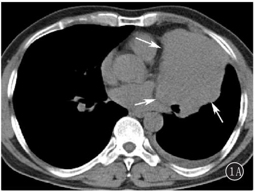 参苓白术散加减治肺门淋巴结结核医案、配方