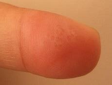 五味消毒饮加减治脓性指头炎医案、配方