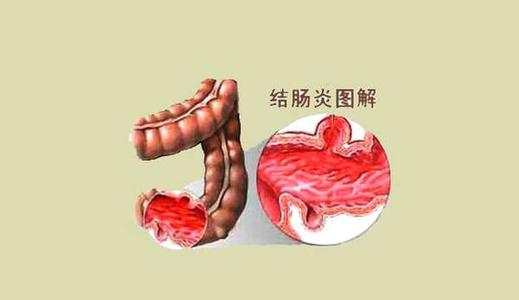 越鞠丸加减治慢性结肠炎医案、配方