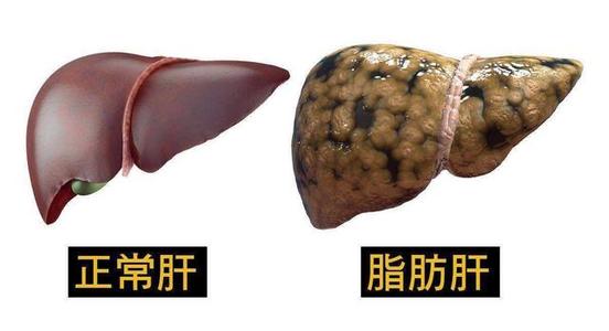 越鞠丸加减治脂肪肝医案、配方