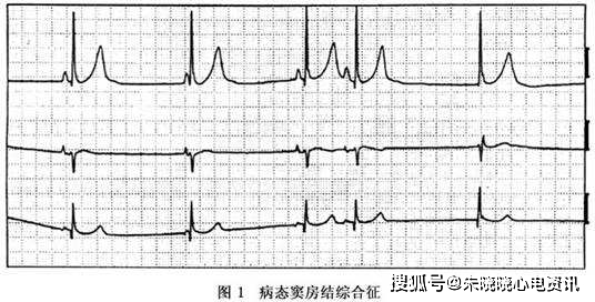 小青龙汤加减治病态窦房结综合征医案、配方