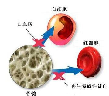 归脾汤加减治再生障碍性贫血医案、配方