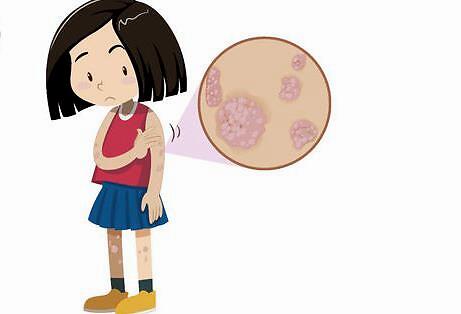 归脾汤加减治银屑病医案、配方