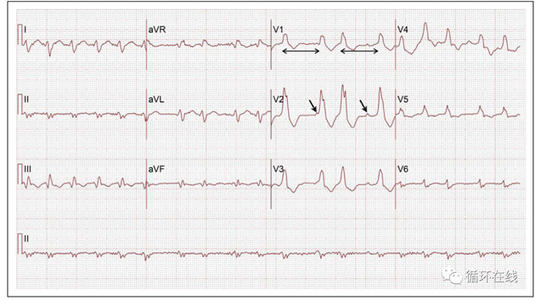生脉散加减治心动过速伴房颤医案、配方