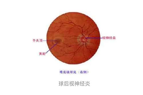生脉散加减治球后视神经炎医案、配方
