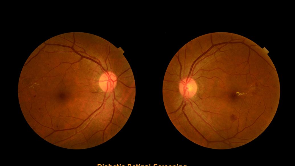 补中益气汤加减治视神经萎缩医案、配方