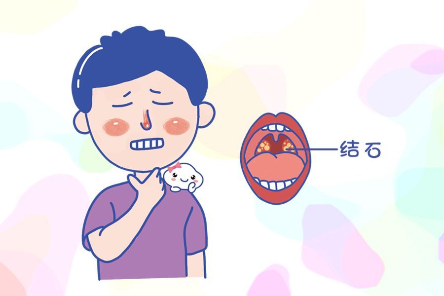 白虎汤加减治急性扁桃体炎医案、配方