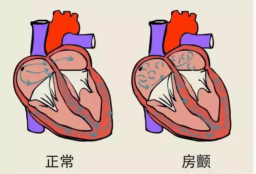 血府逐瘀汤加减治肺癌切除术后合并心房颤动医案、配方